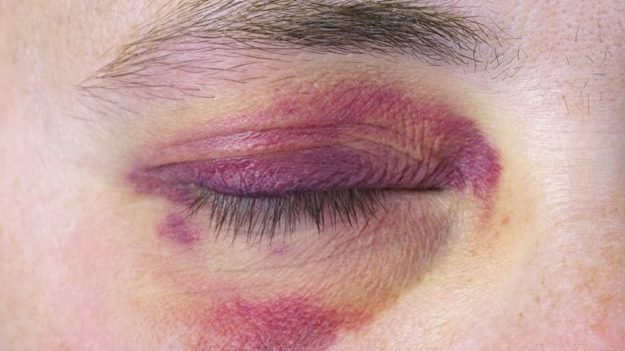 A human eye suffers from a large purple bruise.